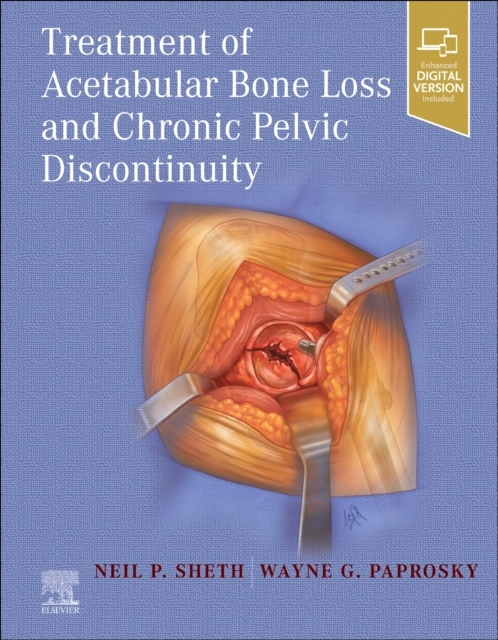 Treatment of Acetabular Bone Loss and Chronic Pelvic Discontinuity Elsevier