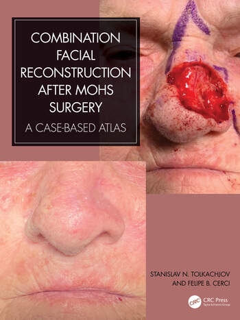 Combination Facial Reconstruction after Mohs Surgery A Case Based Atlas Taylor & Francis Ltd